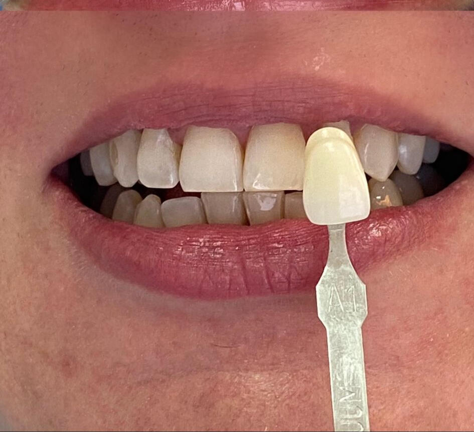 Branqueamento Dentário Dental Mafamude