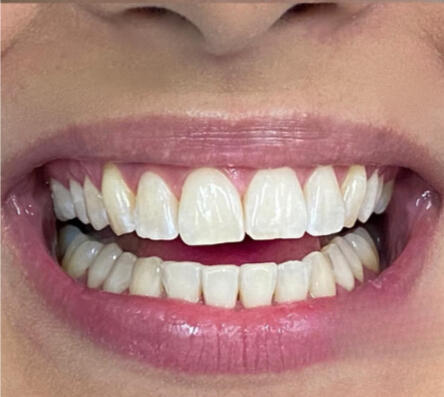Branqueamento Dentário Dental Mafamude
