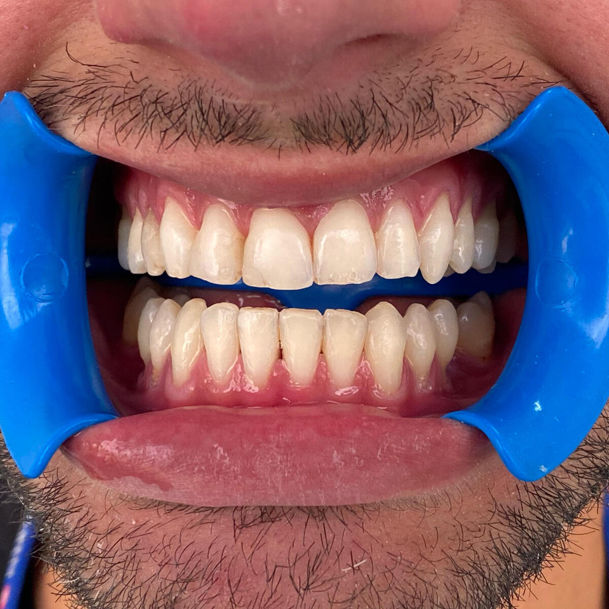 Branqueamento Dentário Dental Mafamude